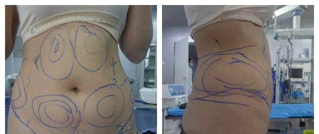 感谢徐州时光洪扬院长曹洪扬多维立体吸脂500ml后让我3个月后告别小肚腩