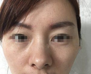 28岁就开始出现面部下垂鼻唇沟明显到徐州时光洪扬做了线雕抗衰中的佼佼者——翊品线，分享术后蜕变