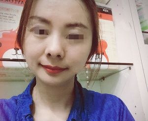 28岁就开始出现面部下垂鼻唇沟明显到徐州时光洪扬做了线雕抗衰中的佼佼者——翊品线,分享术后蜕变 图2