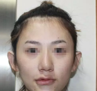 济南宝琳娜做自体脂肪填充挺好的,并且收费价格合理(附照片)