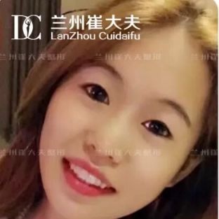 兰州崔大夫做双眼皮好吗 这有他小切口双眼皮1-10天恢复过程图片和案例