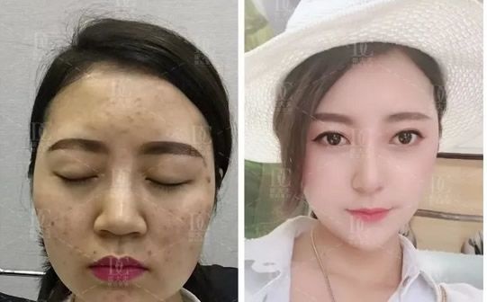 兰州崔大夫整形全肋软骨隆鼻恢复过程和图片 揭秘全肋软骨隆鼻会变形吗