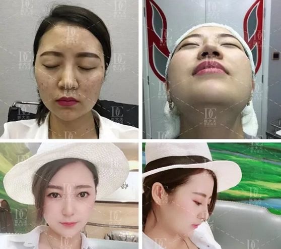 兰州崔大夫整形全肋软骨隆鼻恢复过程和图片 揭秘全肋软骨隆鼻会变形吗 图2