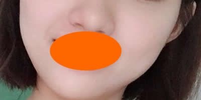 宜春天泽美容医院周玲整形案例:微整祛痘+缩小毛孔术后40天恢复过程及效果展示 图2