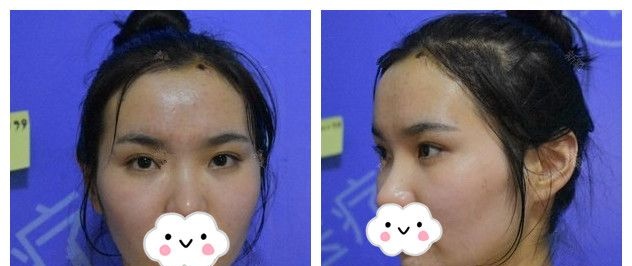 太阳穴凹陷影响运势的我到徐州时光洪扬做了自体脂肪填充 30ml带来的改变是工作爱情双丰收