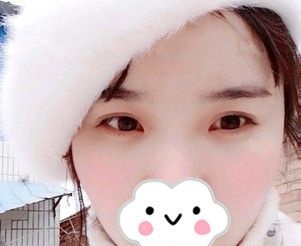 太阳穴凹陷影响运势的我到徐州时光洪扬做了自体脂肪填充 30ml带来的改变是工作爱情双丰收 图2
