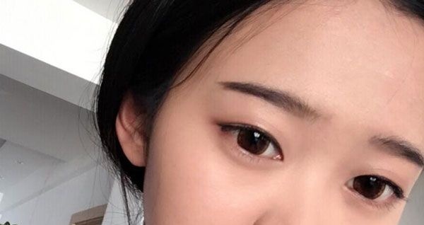好开心哟!找昆明艺星金辉做眼综合+提肌60天效果很自然,价格很合理