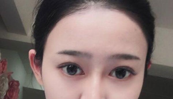 好开心哟！找昆明艺星金辉做眼综合+提肌60天效果很自然，价格很合理 案例图2
