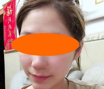 真没想到花2800元找赣州韩美整形吴彩霞做微针祛痘后,仅仅1个月脸部痘痘痘印都没了 图2
