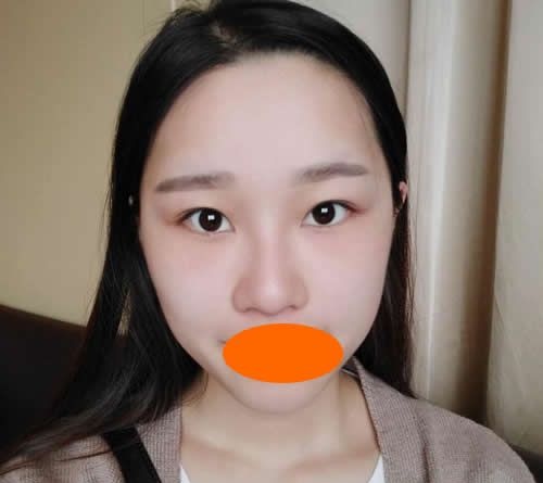 肿泡眼的我找赣州韩美何斌主任割7mm双眼皮一个月后真的有了网红双眼皮
