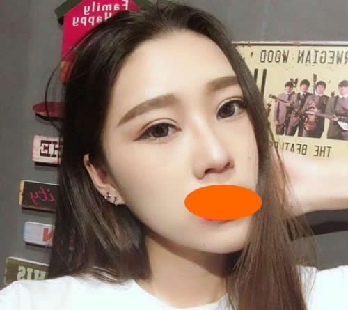 肿泡眼的我找赣州韩美何斌主任割7mm双眼皮一个月后真的有了网红双眼皮 图2