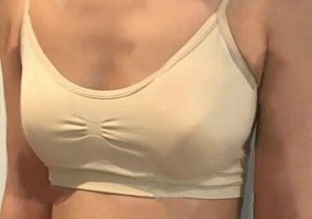 看了赣州韩美整形医院隆胸真人实例和价格后,我做了290CC傲诺拉假体隆胸很满意