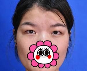 筛选了徐州排行前五的医院后选定时光洪扬，仅40分钟双眼皮+开内眼角就让我从肿眼泡变身大眼美女