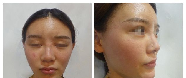 提前了解过自体脂肪填充成活率、恢复、风险等问题后 在徐州时光洪扬做了全面部脂肪移植