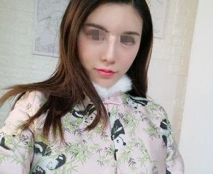 提前了解过自体脂肪填充成活率、恢复、风险等问题后 在徐州时光洪扬做了全面部脂肪移植 图2