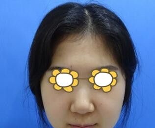 沈阳哪个医生隆鼻做得好？快看沈阳名流医疗美容医院王松给我做的假体隆鼻术后30天效果怎么样？