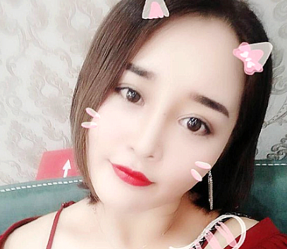 我去佛山梦露找孙文娜医生做完双眼皮隆鼻后又做了面部吸脂和祛痘,大家看效果怎么样 图2