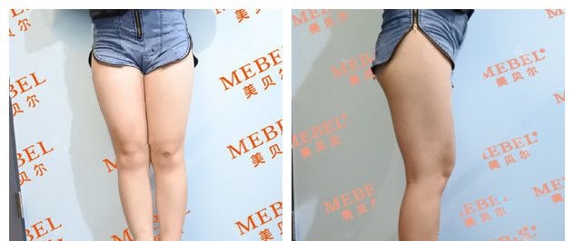 看过邹志英分享的2019吸脂价格表 我选择到常州美贝尔做了吸脂瘦大腿参与优惠活动价格划算
