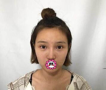自体脂肪填充面部多久恢复自然呢?用我在辽宁曙光整形外科医院做自体脂肪全脸填充术后64天效果揭秘!