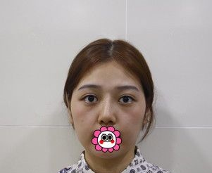 面部条件不错的我找哈尔滨臻美王丹丹做了硅胶隆鼻+自体脂肪填充后五官更加立体