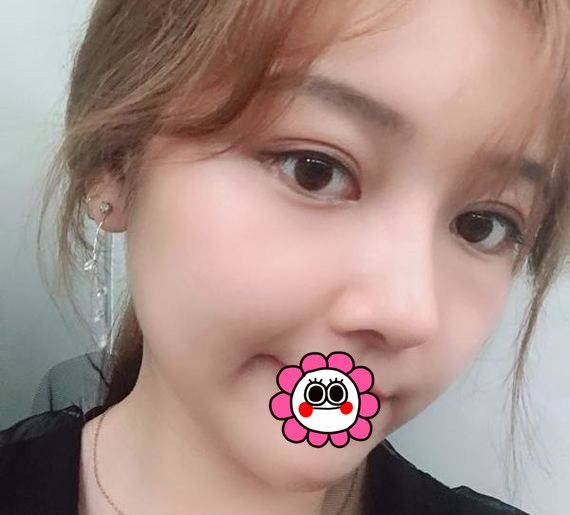 面部条件不错的我找哈尔滨臻美王丹丹做了硅胶隆鼻+自体脂肪填充后五官更加立体 图2
