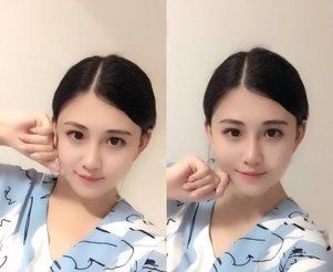 说说我到哈尔滨索菲找陈富全用耳软骨隆鼻的心路历程，顺便整理了一份鼻整形价格表 案例图2