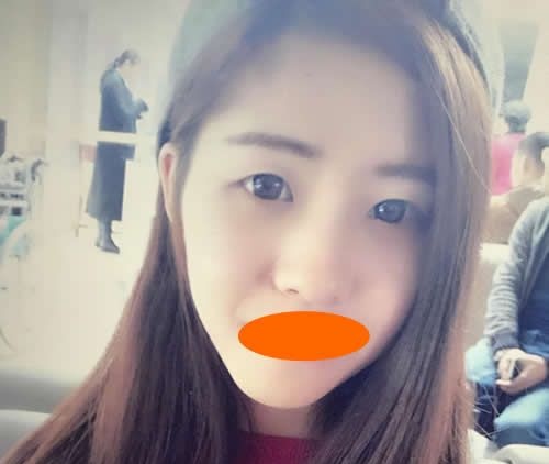 在赣州华美整形赵亚均院长建议下我一起做了割双眼皮+隆鼻,大家觉得效果怎么样