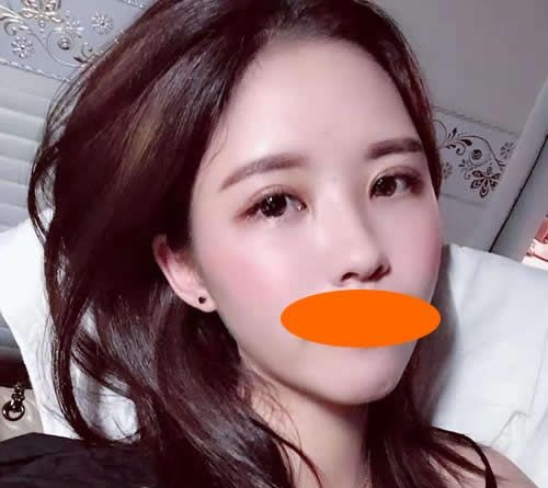 在赣州华美整形赵亚均院长建议下我一起做了割双眼皮+隆鼻,大家觉得效果怎么样 图2