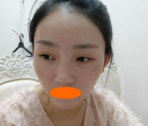一个月前找赣州华美整形赵亚均做了自体脂肪填充全脸,朋友都说术后效果堪比川剧变脸哦