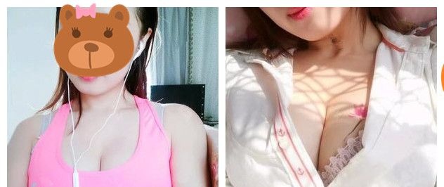 相比国产威宁我选择价格略贵的美国进口曼托假体 再加上常州美贝尔内窥镜+双平面技术术后胸部自然无异物感 图2