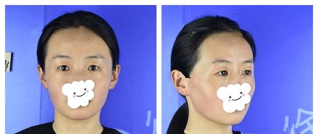 征募上徐州时光洪扬的模特后挑战了以全切双眼皮为主的眼综合加上自体脂肪面部填充 还拿到价格参考表