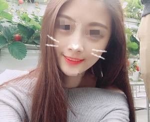 虽然快一万的自体脂肪填充比线雕价格贵,但是选对常州美贝尔专业医院术后没有后遗症成活率还高 图2