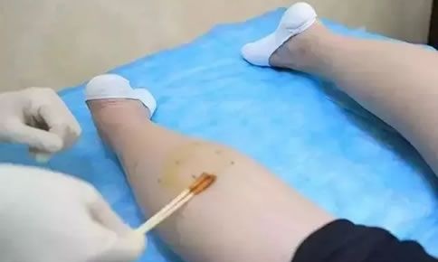 腿短且粗真是要命,还好有嘉兴禾美的瘦腿让我的小粗腿轻松从42cm瘦到33cm