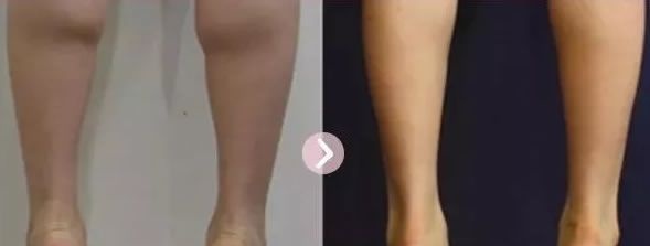 腿短且粗真是要命,还好有嘉兴禾美的瘦腿让我的小粗腿轻松从42cm瘦到33cm 图2