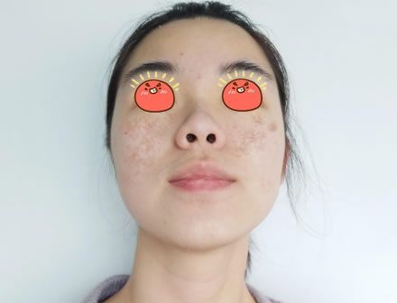 在绍兴维美整形医院做完皮秒激光祛斑后,我发现我解锁了新形象,而且手术收费不高