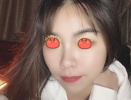 在绍兴维美整形医院做完皮秒激光祛斑后，我发现我解锁了新形象,而且手术收费不高 案例图2