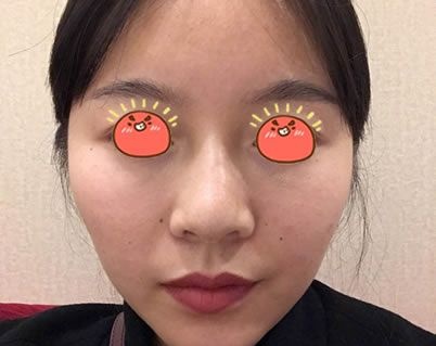 看本仙女3个月前找金华亚美邓泽臣做的吸脂加自体脂肪面部填充的效果怎么样