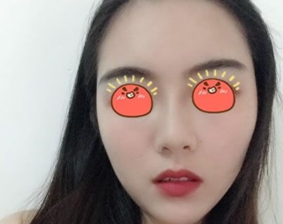 看本仙女3个月前找金华亚美邓泽臣做的吸脂加自体脂肪面部填充的效果怎么样 图2