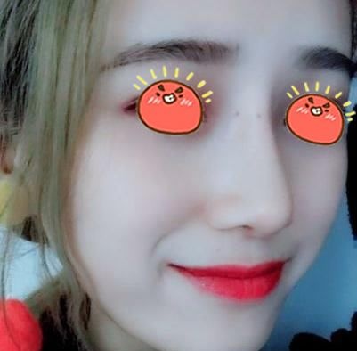 二次做隆鼻经历,金华瑞丽鼻综合修复手术结束我做隆鼻失败的噩梦!!! 图2