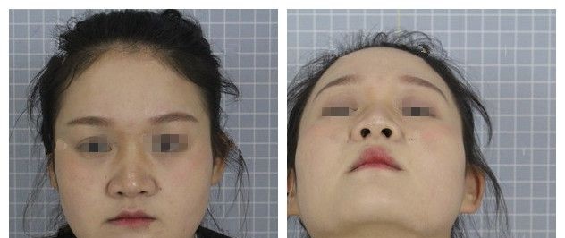 羡慕闺蜜的高鼻梁小V脸就对比常州前三名整形医院后选定美贝尔做了鼻部综合整形+瘦脸