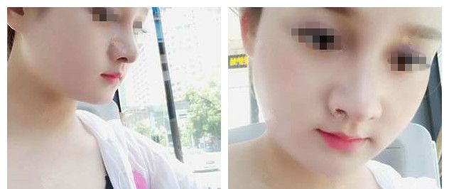 羡慕闺蜜的高鼻梁小V脸就对比常州前三名整形医院后选定美贝尔做了鼻部综合整形+瘦脸 图2