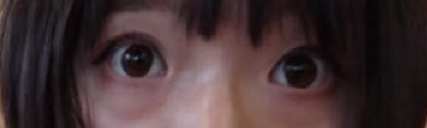 济南做去眼袋手术好的医院是济南美莲,分享我在美莲做的去眼袋以及脂肪填充日记