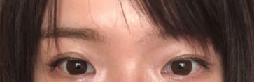 济南做去眼袋手术好的医院是济南美莲,分享我在美莲做的去眼袋以及脂肪填充日记 图2