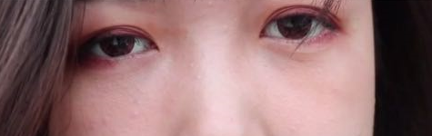 总结我在威海做了内切去眼袋+自体脂肪填充泪沟后的一些心得and照片和注意事项 图2