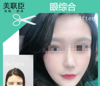 大概2月底去淄博做了去眼袋手术恢复了4个月了，我今天分享我的照片+心得 案例图2