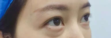 菏泽华美做去眼袋和自体脂肪填充手术都挺好的,分享我术后三个月的恢复情况