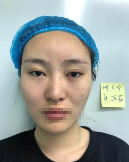 双眼皮宽窄不一致的我到郑州艺龄做了双眼皮+开眼角 艺速明星眼真的让我灿若欧美大眼妹