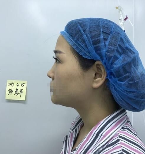 实话实说:在郑州艺龄做的鼻综合整形的确是我一生都不会后悔的决定