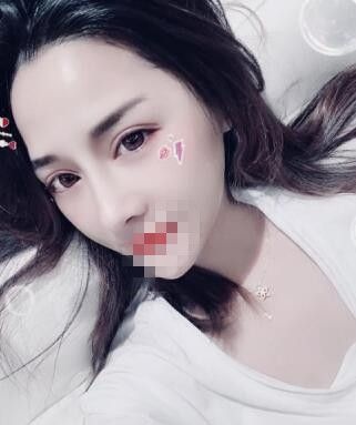 实话实说:在郑州艺龄做的鼻综合整形的确是我一生都不会后悔的决定 图2