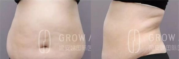 前年做的腰腹吸脂没效果,今年在长春姬安娣整形吸脂瘦腹后终于圆了我的减肥梦!
